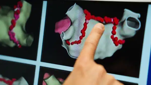 ablasyon tedavisi kalp pili ve sok piline alternatif cozum PX9lRjTH