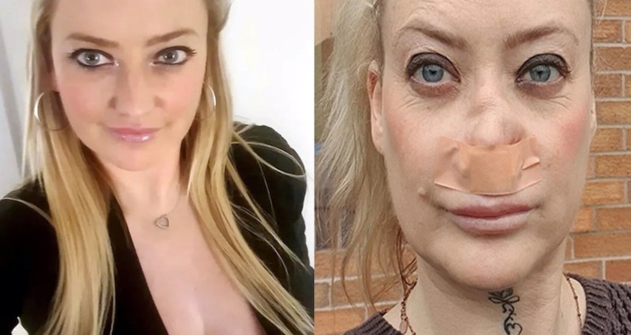 Antalya tatilinde dişlerini yaptıran turistin burnu çöktü!